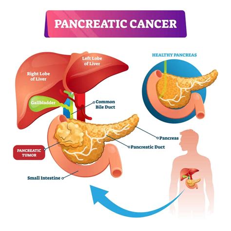 For locally advanced . . Can colonoscopy detect pancreatic cancer